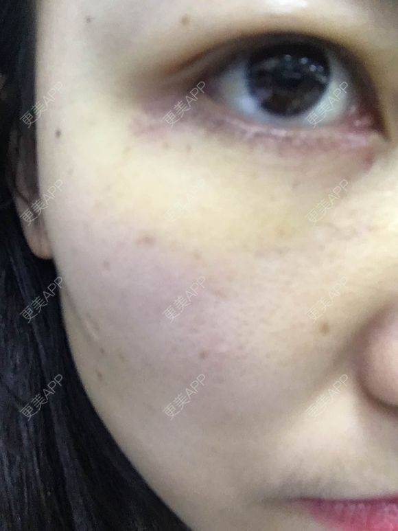 更美 - 一帘幽梦w的外切去眼袋经验 | 成都 | 外切去眼袋