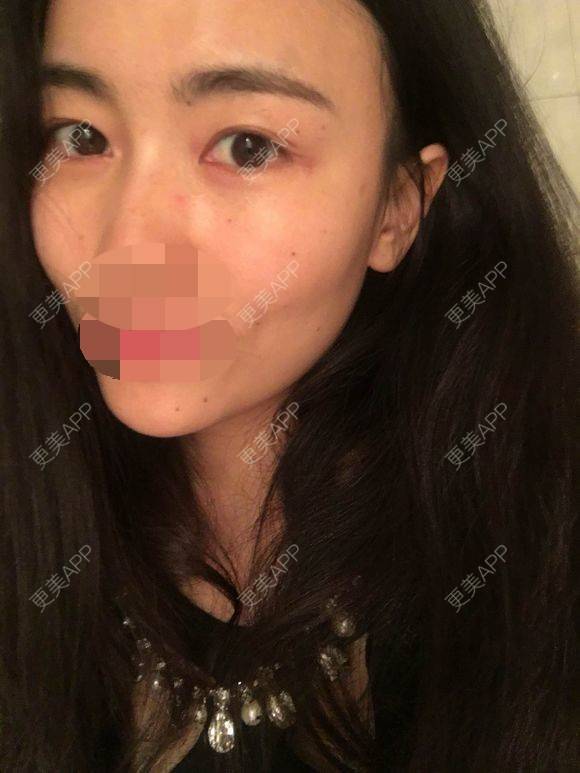 更美 - 一帘幽梦w的外切去眼袋经验 | 成都 | 外切去眼袋