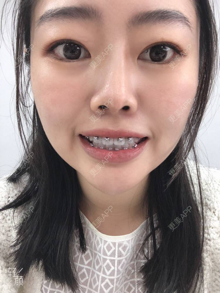 更美用户irasa98orh的牙齿整形日记