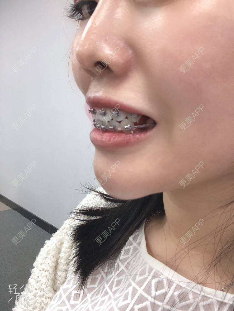 更美用户irasa98orh的牙齿整形日记
