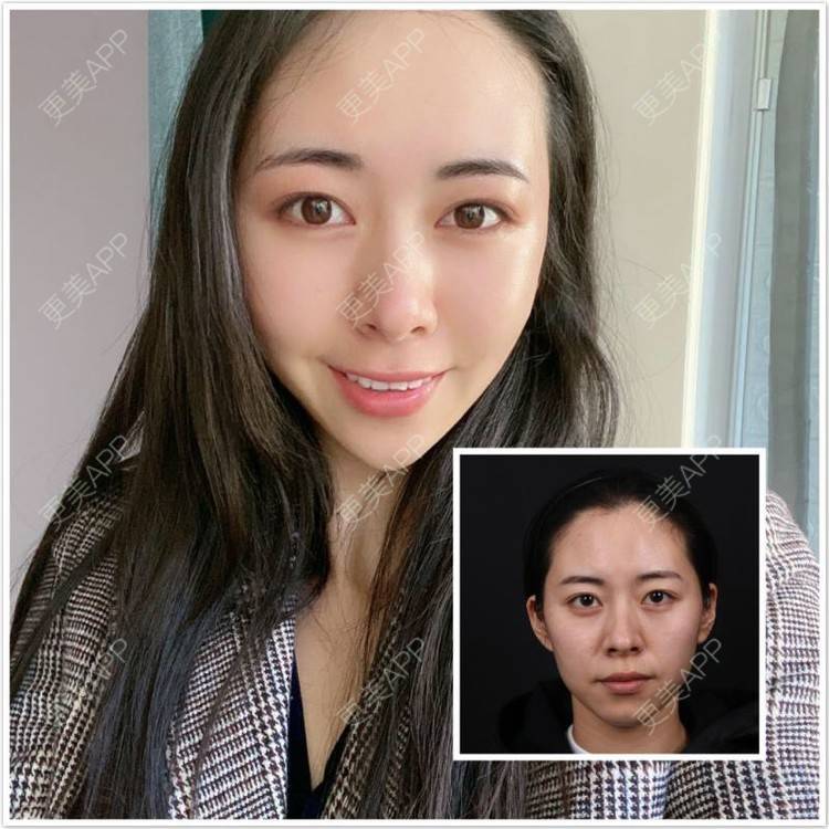 更美 - 杨大平 医生的假体垫苹果肌经验 | 更美研究所 | 假体垫苹果肌 | 北京