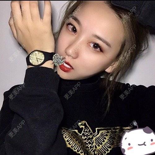更美 - 更美用户p2CNi7da5u的鼻部多项经验 | 鼻部多项 | 苏州 | 耳软骨隆鼻