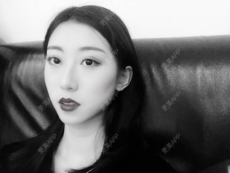 更美 - 李桥莲 医生的鼻翼缩小经验 | 视频日记 | 鼻翼缩小 | 泉州