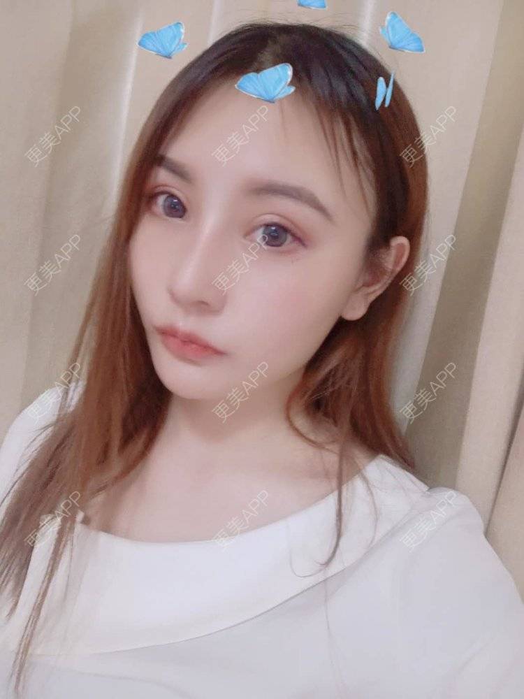 更美 - 更美用户U6Pt7ApV7A的吸脂瘦脸经验 | 吸脂瘦脸 | 重庆