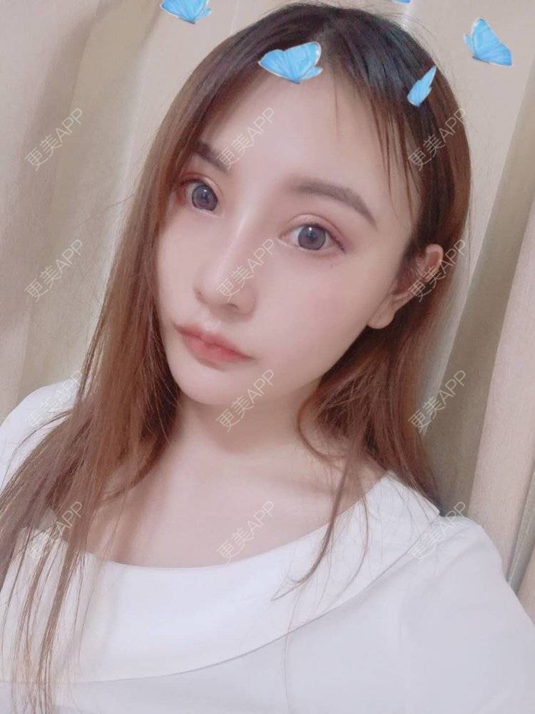 更美 - 更美用户U6Pt7ApV7A的吸脂瘦脸经验 | 吸脂瘦脸 | 重庆