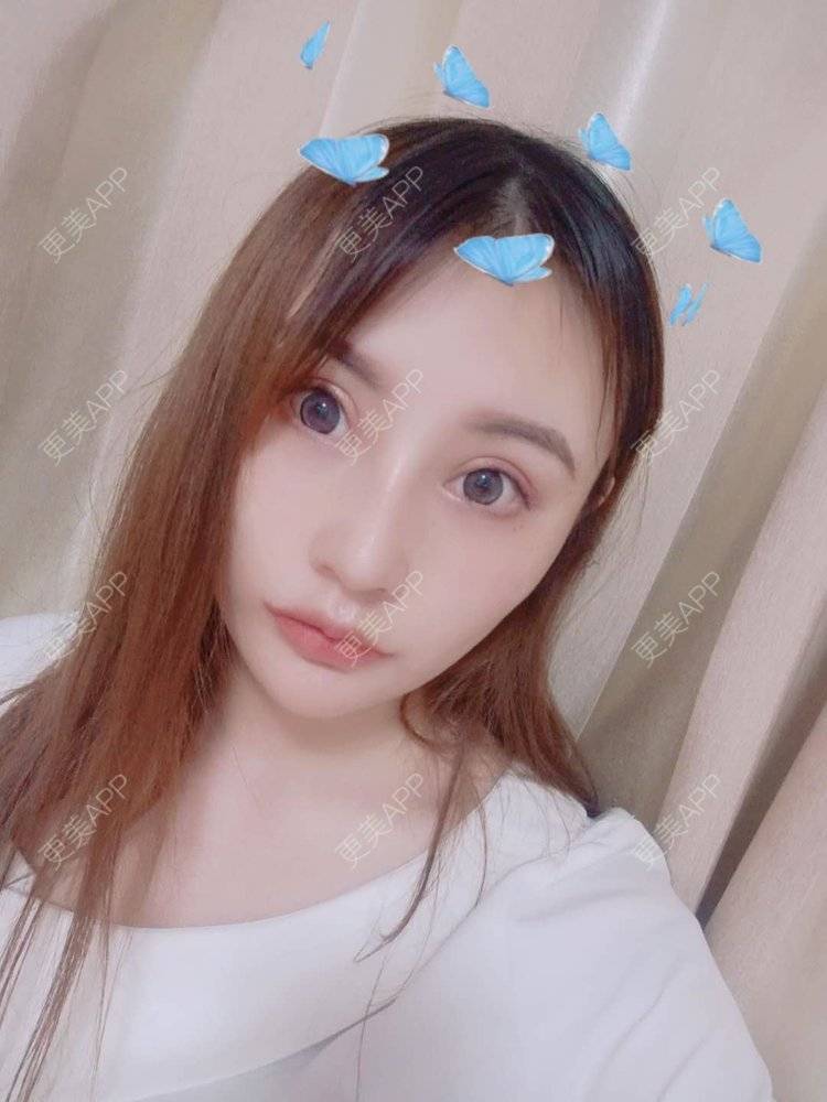 更美 - 更美用户U6Pt7ApV7A的吸脂瘦脸经验 | 吸脂瘦脸 | 重庆