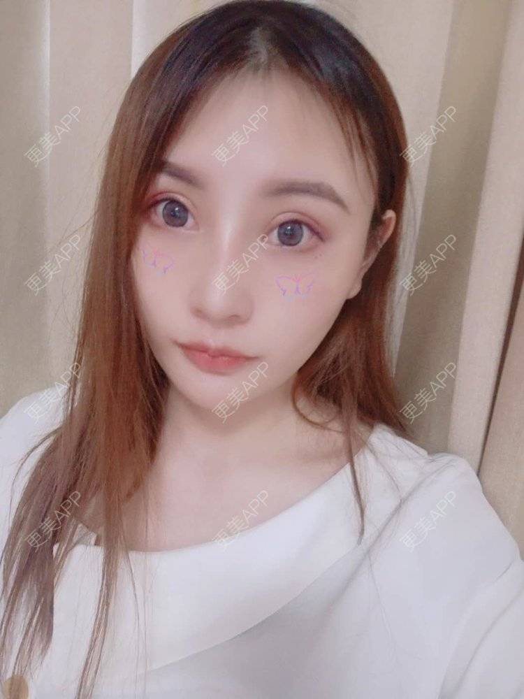 更美 - 更美用户U6Pt7ApV7A的吸脂瘦脸经验 | 吸脂瘦脸 | 重庆