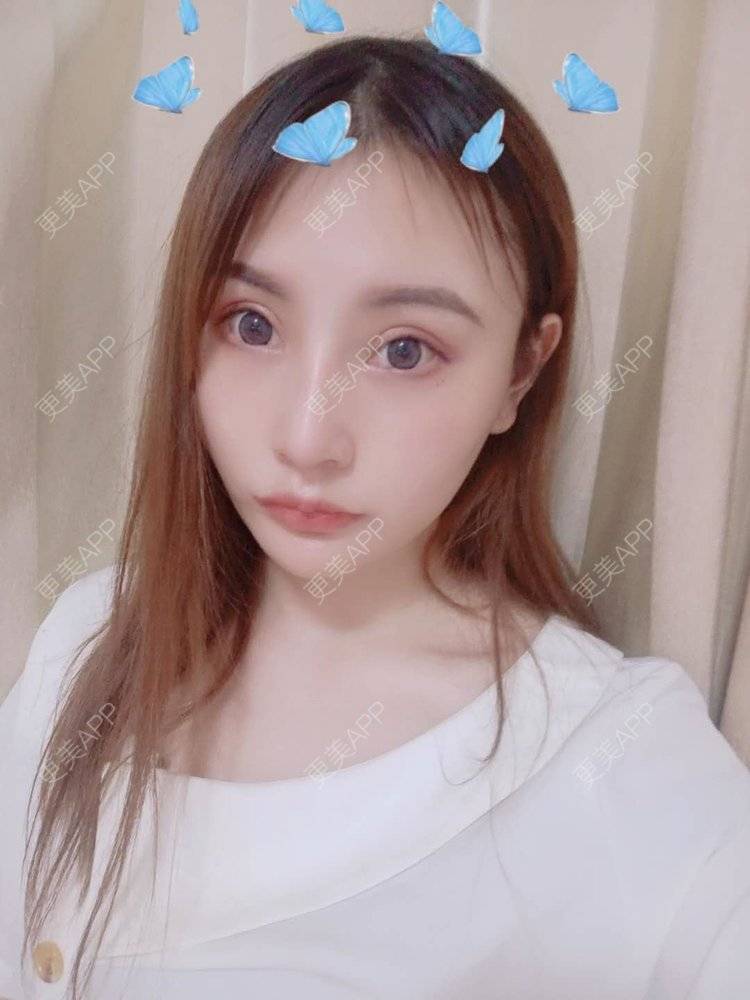 更美 - 更美用户U6Pt7ApV7A的吸脂瘦脸经验 | 吸脂瘦脸 | 重庆