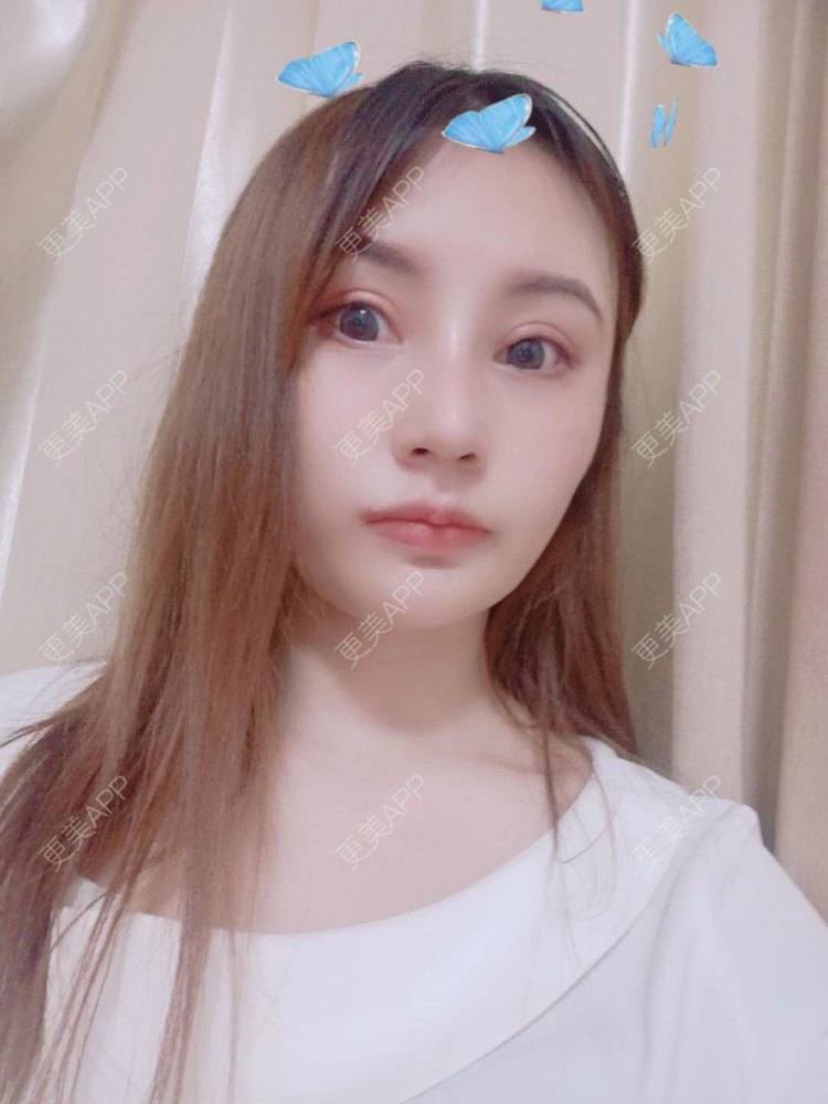 更美 - 更美用户U6Pt7ApV7A的吸脂瘦脸经验 | 吸脂瘦脸 | 重庆