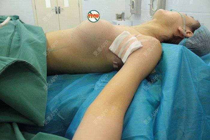 更美 - 更美用户TsqtLGm8wN的自体脂肪隆胸经验 | 自体脂肪隆胸 | 长沙