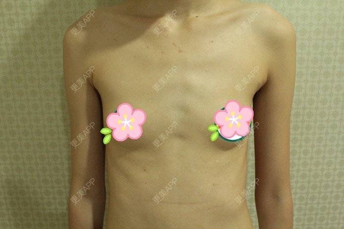 更美 - 更美用户TsqtLGm8wN的自体脂肪隆胸经验 | 自体脂肪隆胸 | 长沙