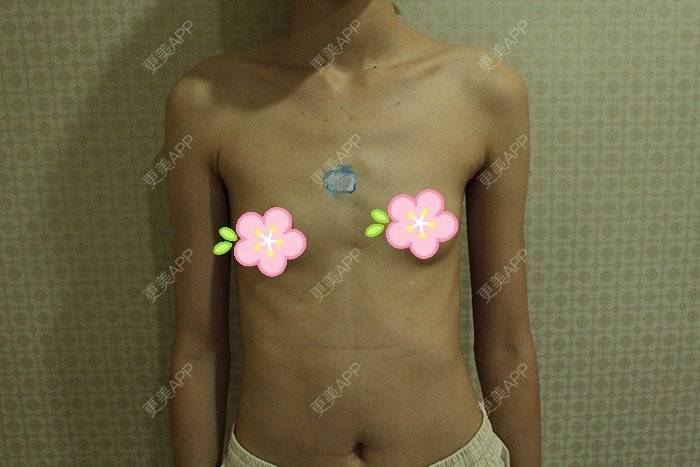 更美 - 更美用户TsqtLGm8wN的自体脂肪隆胸经验 | 自体脂肪隆胸 | 长沙