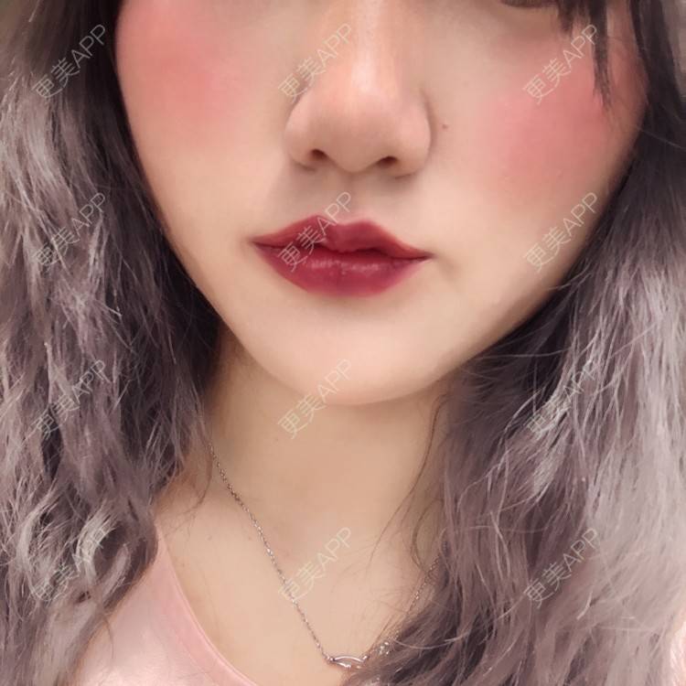 更美 - 男朋友是彭于晏的M唇成形经验 | M唇成形 | 杭州