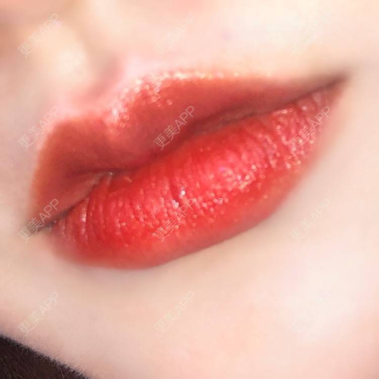 更美 - 男朋友是彭于晏的M唇成形经验 | M唇成形 | 杭州