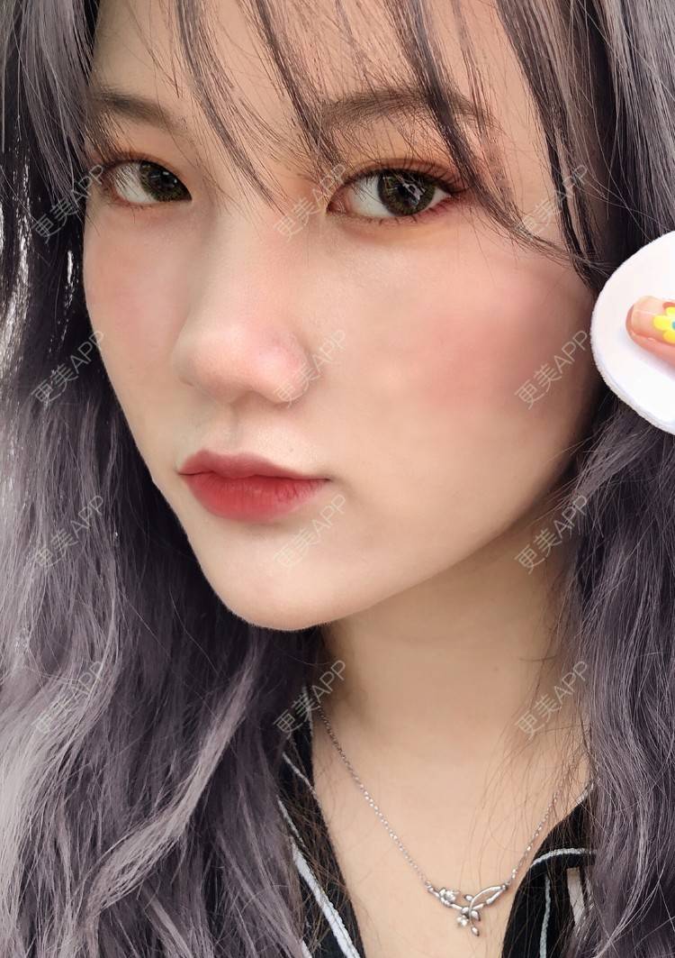 更美 - 男朋友是彭于晏的M唇成形经验 | M唇成形 | 杭州