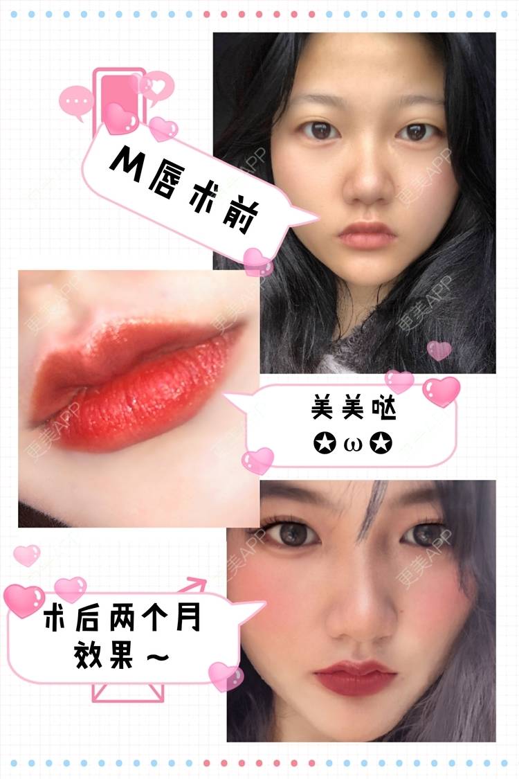 更美 - 男朋友是彭于晏的M唇成形经验 | M唇成形 | 杭州