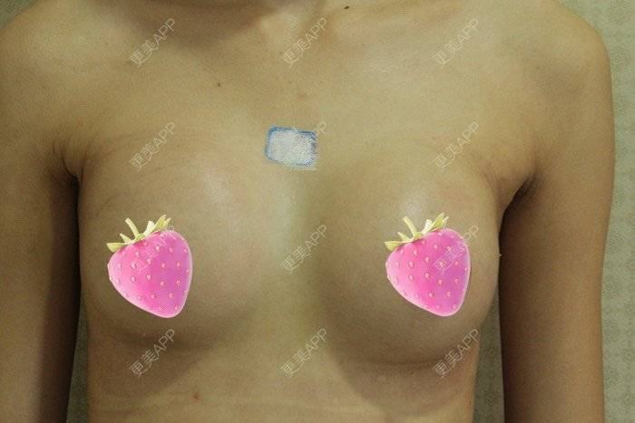 更美 - 更美用户TsqtLGm8wN的自体脂肪隆胸经验 | 自体脂肪隆胸 | 长沙