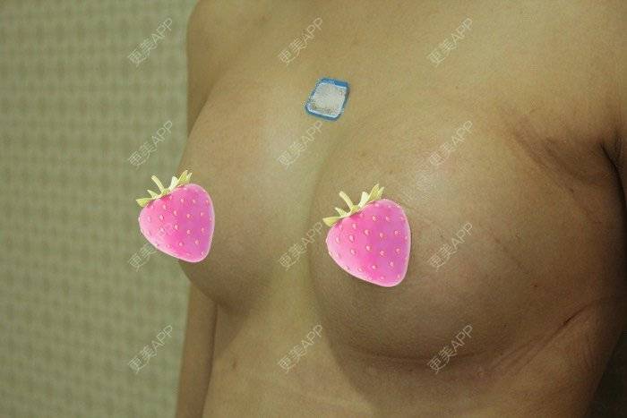 更美 - 更美用户TsqtLGm8wN的自体脂肪隆胸经验 | 自体脂肪隆胸 | 长沙