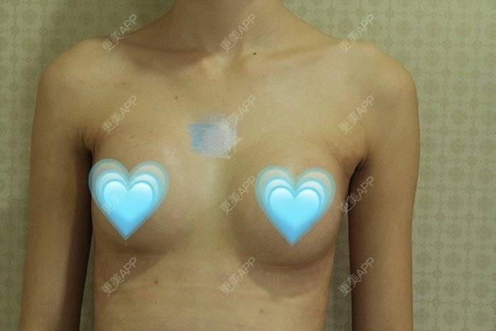 更美 - 更美用户TsqtLGm8wN的自体脂肪隆胸经验 | 自体脂肪隆胸 | 长沙