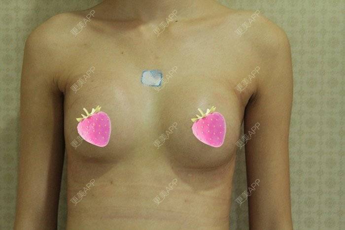 更美 - 更美用户TsqtLGm8wN的自体脂肪隆胸经验 | 自体脂肪隆胸 | 长沙