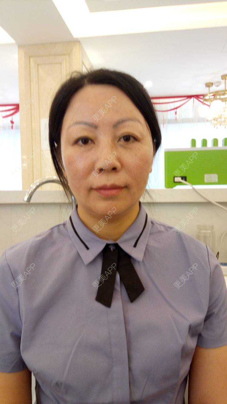 更美 - 更美用户u3zFY6hL8g的自体脂肪全面部填充经验 | 视频日记 | 深圳 | 自体脂肪全面部填充