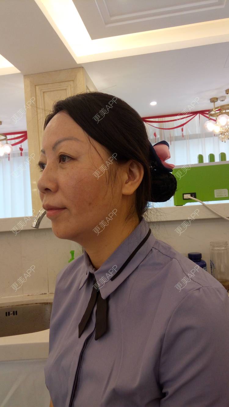 更美 - 更美用户u3zFY6hL8g的自体脂肪全面部填充经验 | 视频日记 | 深圳 | 自体脂肪全面部填充