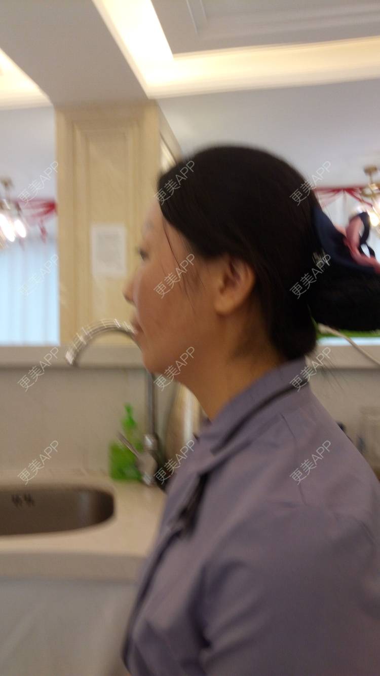 更美 - 更美用户u3zFY6hL8g的自体脂肪全面部填充经验 | 视频日记 | 深圳 | 自体脂肪全面部填充