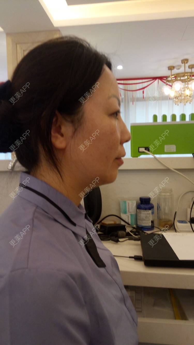 更美 - 更美用户u3zFY6hL8g的自体脂肪全面部填充经验 | 视频日记 | 深圳 | 自体脂肪全面部填充