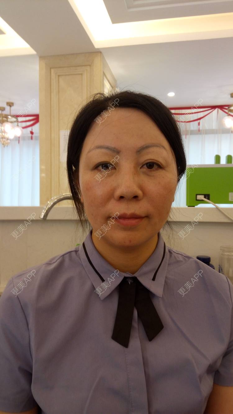 更美 - 更美用户u3zFY6hL8g的自体脂肪全面部填充经验 | 视频日记 | 深圳 | 自体脂肪全面部填充