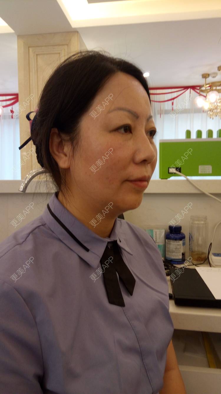 更美 - 更美用户u3zFY6hL8g的自体脂肪全面部填充经验 | 视频日记 | 深圳 | 自体脂肪全面部填充