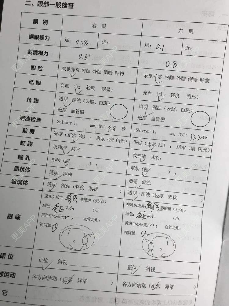 更美 - 深圳华厦眼科的准分子激光原位角膜磨镶术经验 | 准分子激光原位角膜磨镶术 | 深圳