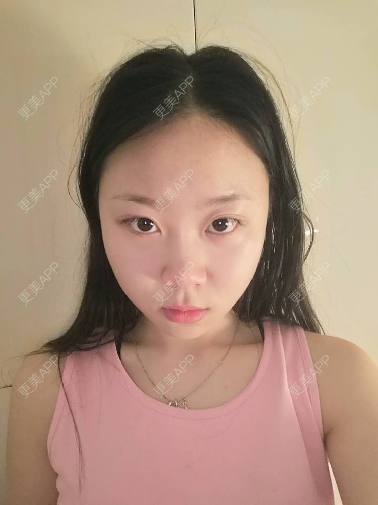 更美 - 更美用户vFETzv4uga的自体脂肪全面部填充经验 | 自体脂肪全面部填充 | 广州