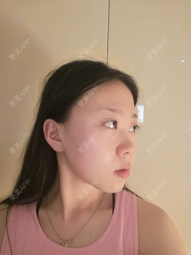 更美 - 更美用户vFETzv4uga的自体脂肪全面部填充经验 | 自体脂肪全面部填充 | 广州