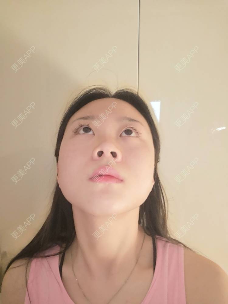 更美 - 更美用户vFETzv4uga的自体脂肪全面部填充经验 | 自体脂肪全面部填充 | 广州