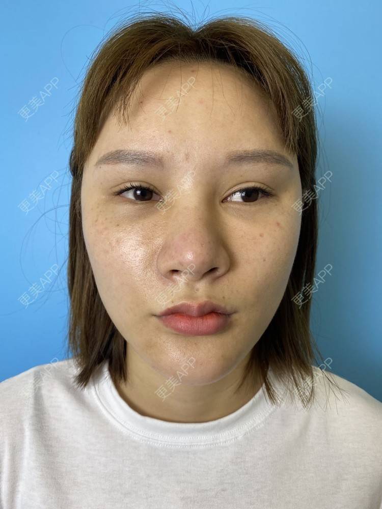 更美 - 上海爱度医疗美容门诊部的隆鼻经验 | 隆鼻 | 耳软骨隆鼻 | 硅胶隆鼻 | 鼻中隔软骨隆鼻