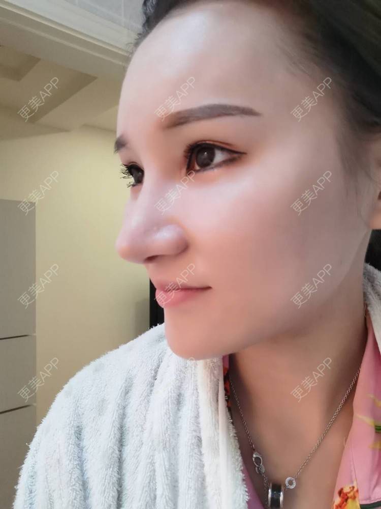 更美 - 上海爱度医疗美容门诊部的隆鼻经验 | 隆鼻 | 耳软骨隆鼻 | 硅胶隆鼻 | 鼻中隔软骨隆鼻