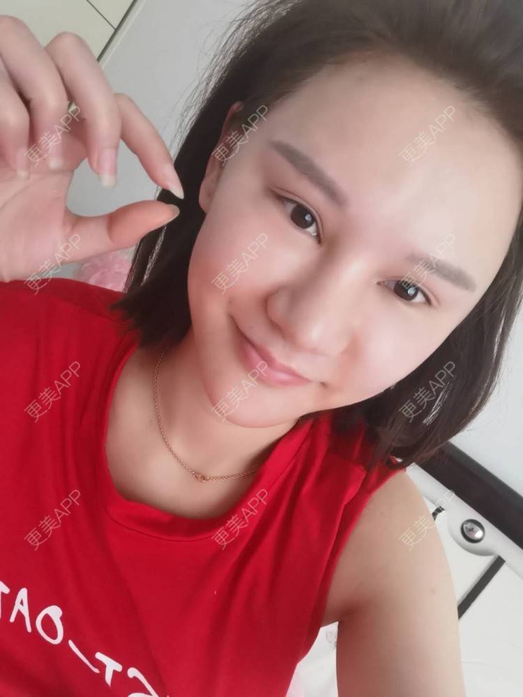 更美 - 上海爱度医疗美容门诊部的隆鼻经验 | 隆鼻 | 耳软骨隆鼻 | 硅胶隆鼻 | 鼻中隔软骨隆鼻