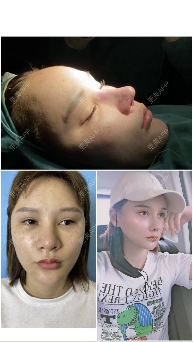 更美 - 上海爱度医疗美容门诊部的隆鼻经验 | 隆鼻 | 耳软骨隆鼻 | 硅胶隆鼻 | 鼻中隔软骨隆鼻