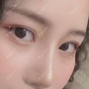 更美 - 圆方脸课代表ʚ😊ɞ的隆鼻经验 | 开内眼角 | 玻尿酸卧蚕 | 假体垫鼻基底 | 鼻部多项 | 自体软骨垫鼻尖 | 隆鼻 | 全切双眼皮 | 硅胶隆鼻 | 南京 | 耳软骨隆鼻 | 视频日记