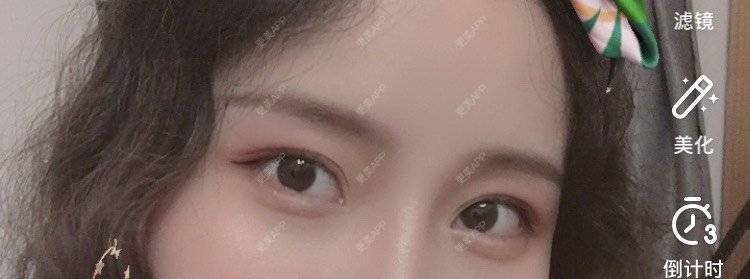更美 - 圆方脸课代表ʚ😊ɞ的隆鼻经验 | 开内眼角 | 玻尿酸卧蚕 | 假体垫鼻基底 | 鼻部多项 | 自体软骨垫鼻尖 | 隆鼻 | 全切双眼皮 | 硅胶隆鼻 | 南京 | 耳软骨隆鼻 | 视频日记