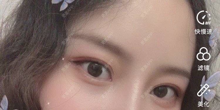 更美 - 圆方脸课代表ʚ😊ɞ的隆鼻经验 | 开内眼角 | 玻尿酸卧蚕 | 假体垫鼻基底 | 鼻部多项 | 自体软骨垫鼻尖 | 隆鼻 | 全切双眼皮 | 硅胶隆鼻 | 南京 | 耳软骨隆鼻 | 视频日记
