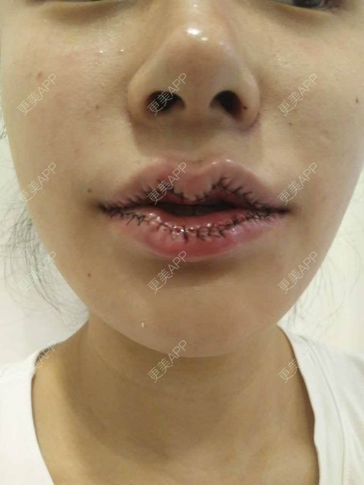 更美用户gynwguunhi的m唇成形日记