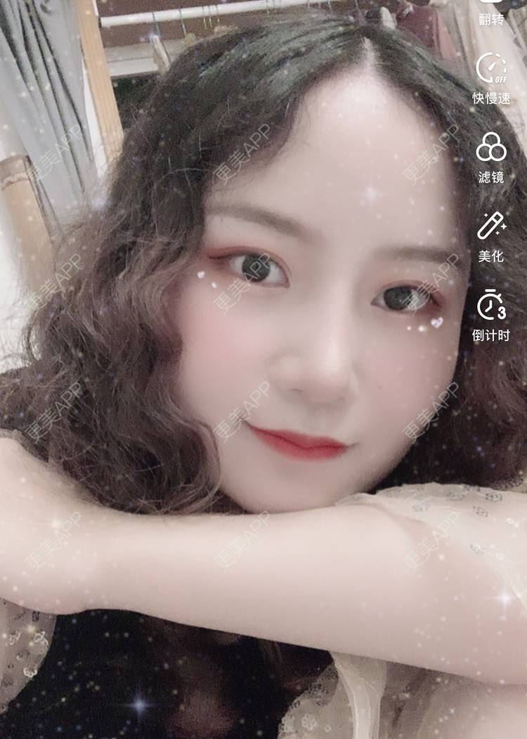 更美 - 圆方脸课代表ʚ😊ɞ的隆鼻经验 | 玻尿酸卧蚕 | 鼻部多项 | 假体垫鼻基底 | 吸脂瘦大腿 | 全飞秒激光术 | 隆鼻 | 全切双眼皮 | 开内眼角 | 自体软骨垫鼻尖 | 硅胶隆鼻 | 南京 | 耳软骨隆鼻 | 视频日记
