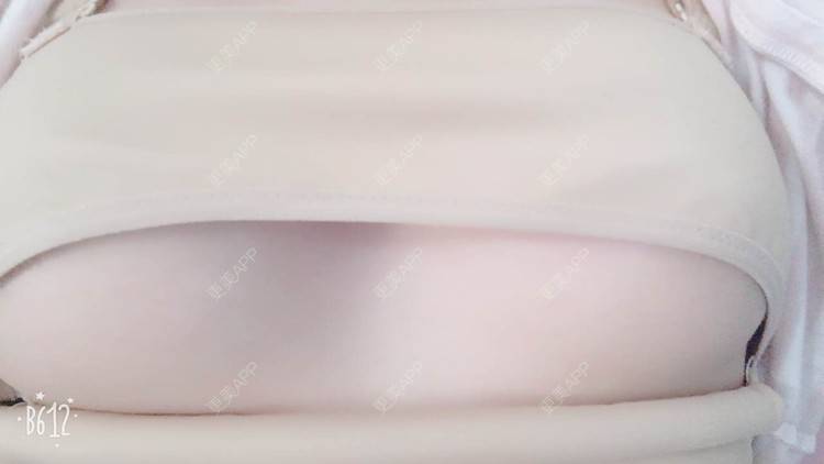 更美 - 更美用户TsqtLGm8wN的自体脂肪隆胸经验 | 自体脂肪隆胸 | 长沙