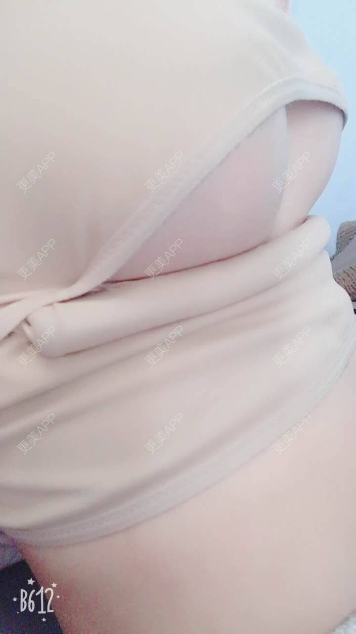 更美 - 更美用户TsqtLGm8wN的自体脂肪隆胸经验 | 自体脂肪隆胸 | 长沙