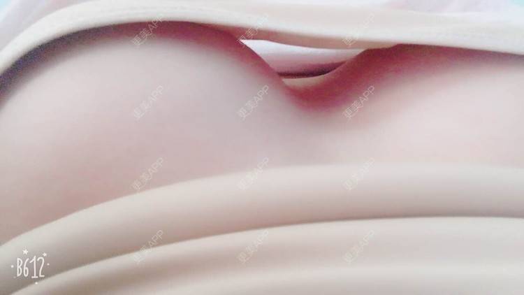 更美 - 更美用户TsqtLGm8wN的自体脂肪隆胸经验 | 自体脂肪隆胸 | 长沙