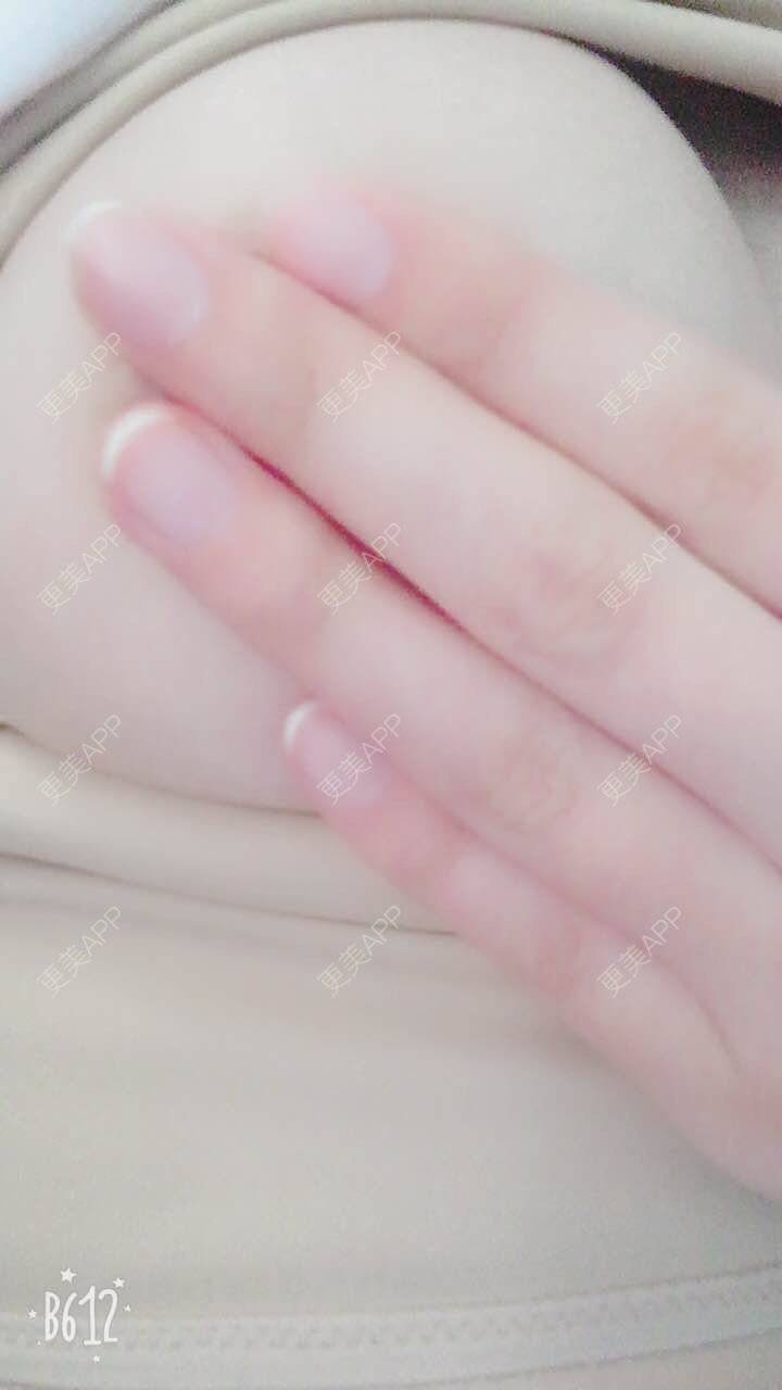 更美 - 更美用户TsqtLGm8wN的自体脂肪隆胸经验 | 自体脂肪隆胸 | 长沙