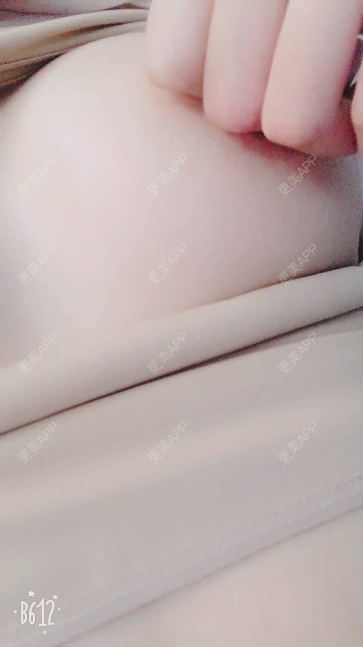 更美 - 更美用户TsqtLGm8wN的自体脂肪隆胸经验 | 自体脂肪隆胸 | 长沙