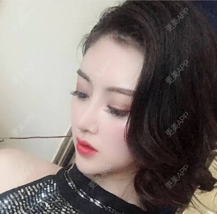 更美 - 穿过旷野的风的耳软骨隆鼻经验 | 耳软骨隆鼻 | 南昌