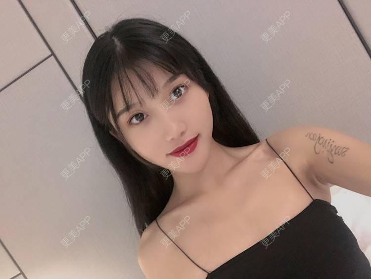 更美 - 木子木可的M唇成形经验 | M唇成形 | 杭州